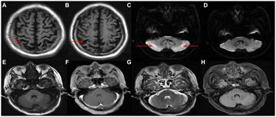 Late-onset cobalamin C deficiency type in adult with cognitive and behavioral disturbances and significant cortical atrophy and cerebellar damage in the MRI: a case report